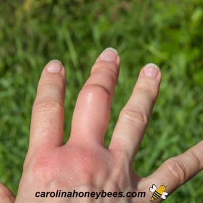 bee sting on finger treatment