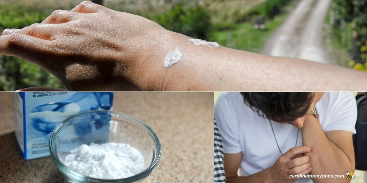 Bee sting swelling and remedy options with baking soda and toothpaste.